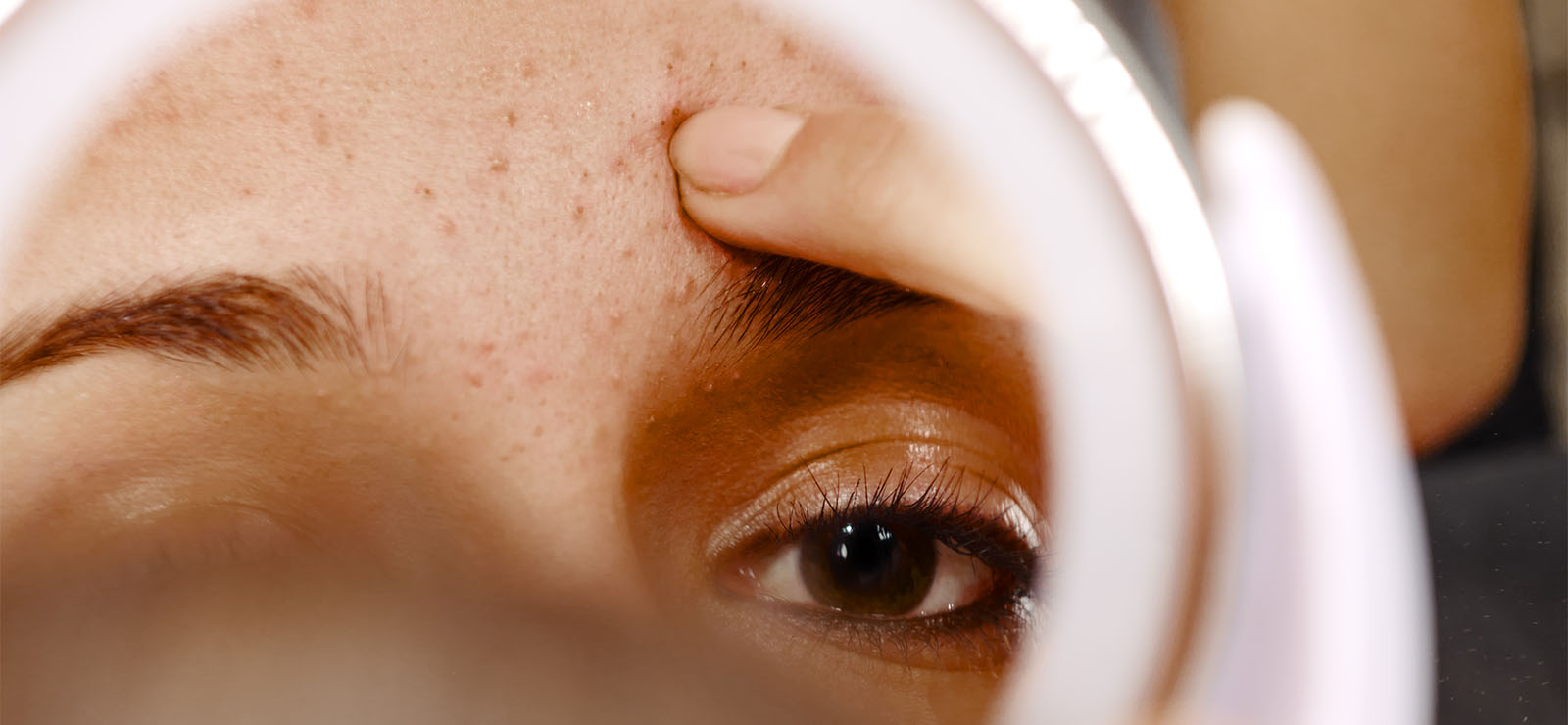 A person looking in a mirror at facial acne.