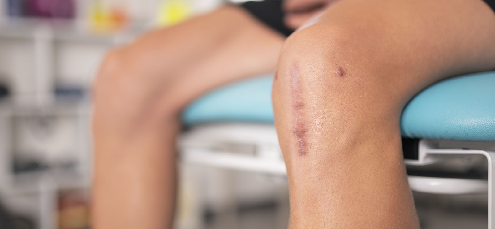 Photo of a knee with stitches.