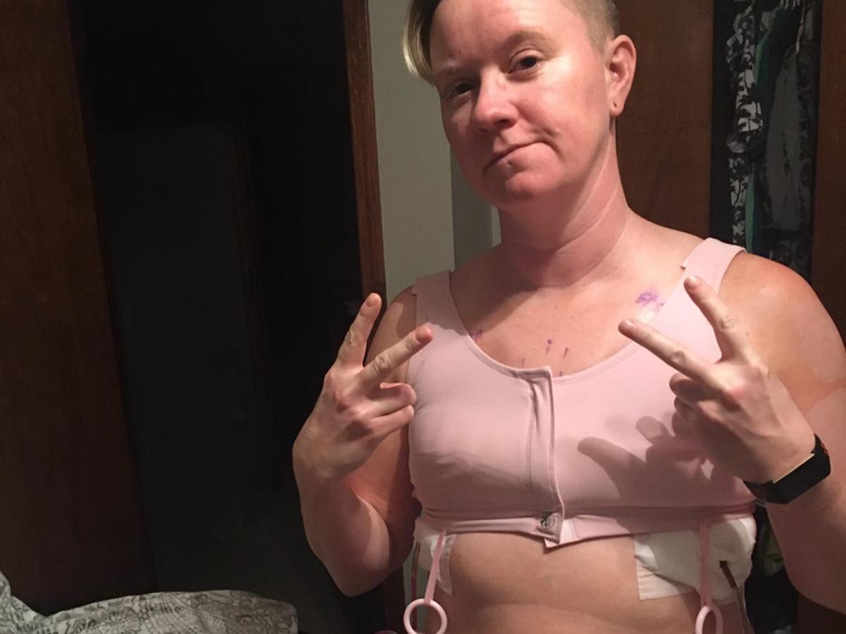 Photo of Double Mastectomy patient post surgery
