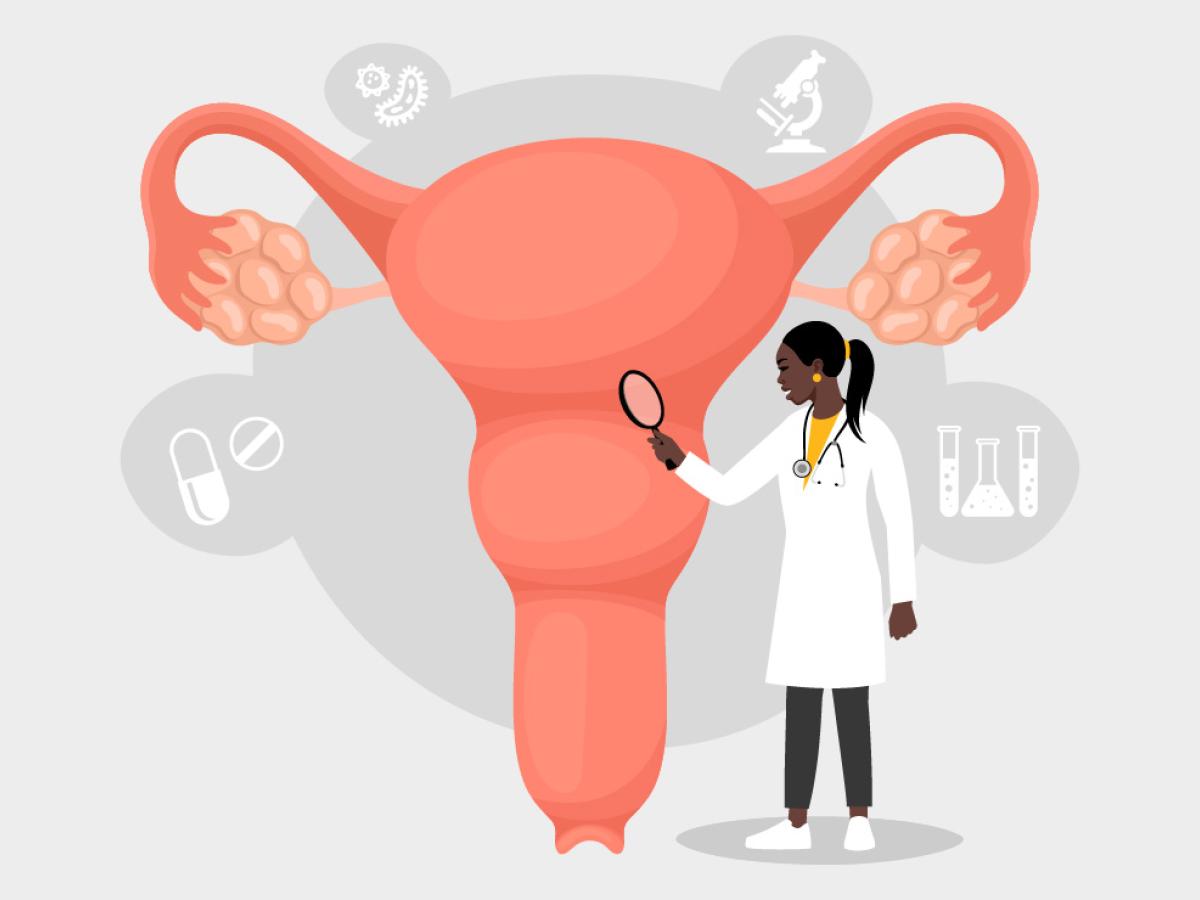 Endometriosis graphic