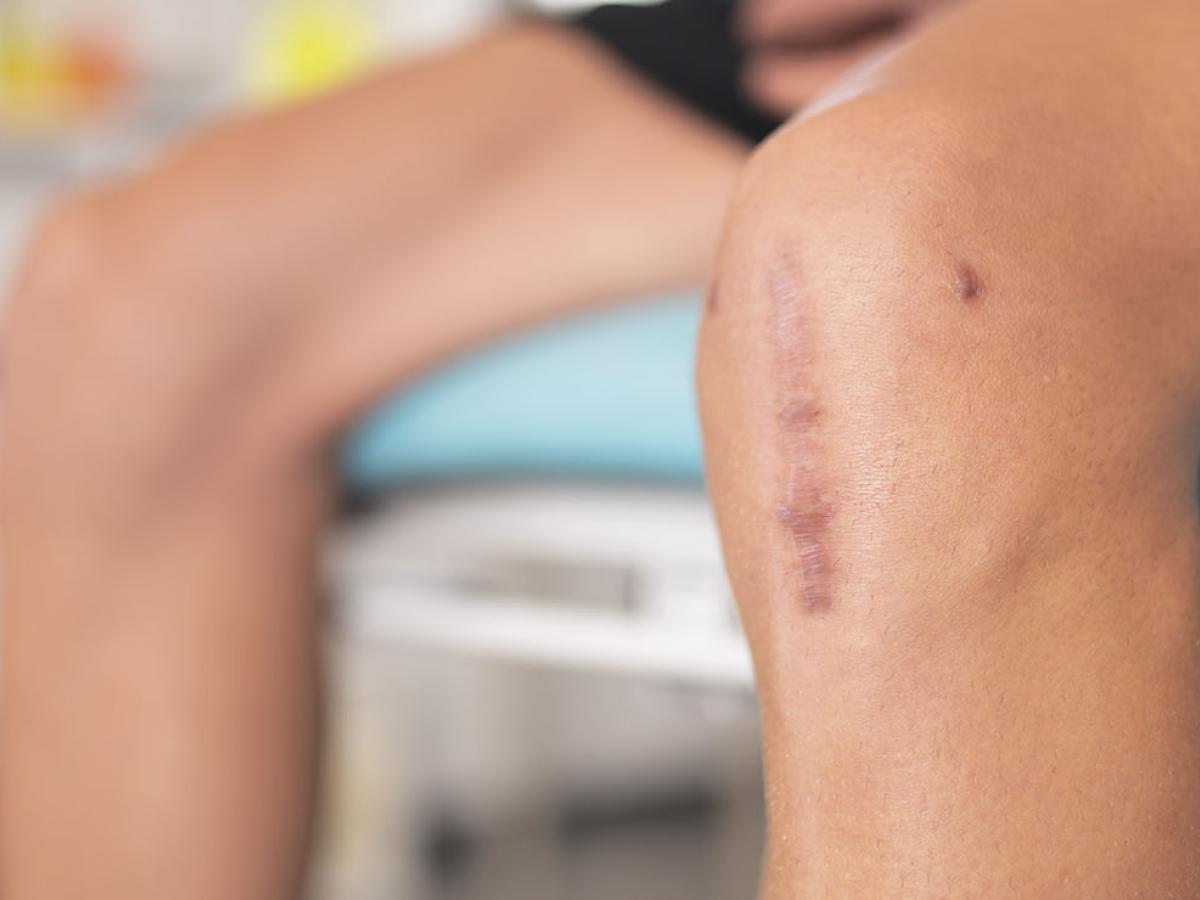 Photo of a knee with stitches.