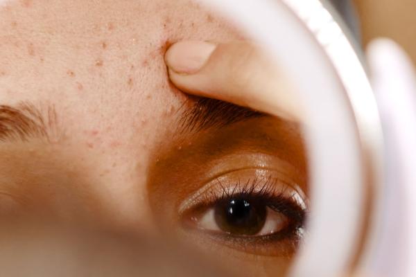 A person looking in a mirror at facial acne.