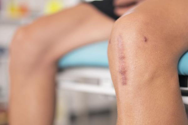 Photo of a knee with stitches.