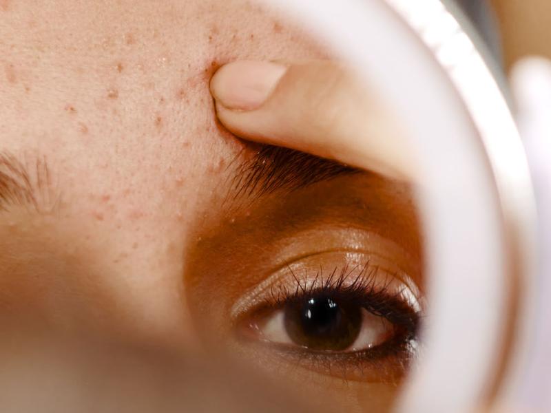 A person looking in a mirror at facial acne.