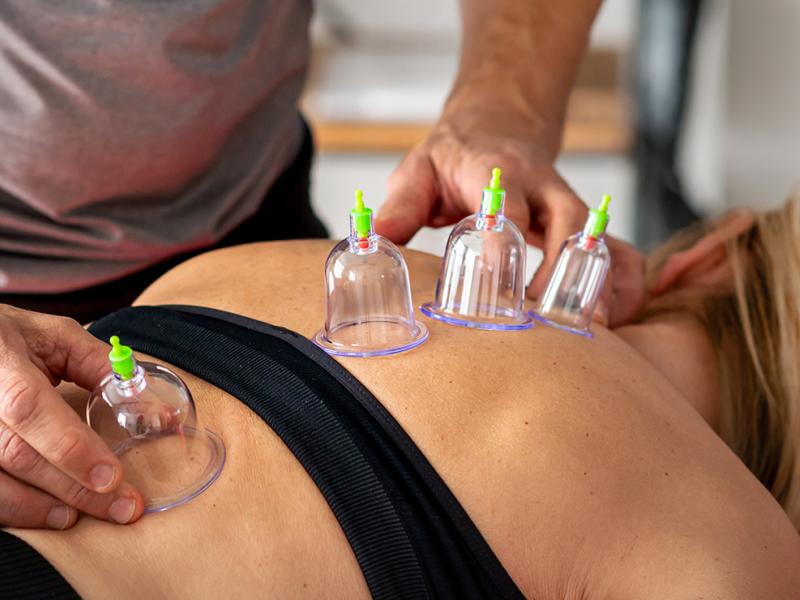 A photo of a woman receiving cupping therapy.